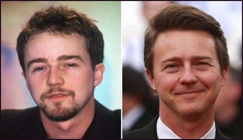 Edward Norton Plastic Surgery Before and After