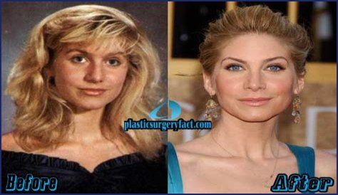 Elizabeth Mitchell Plastic Surgery Before and After